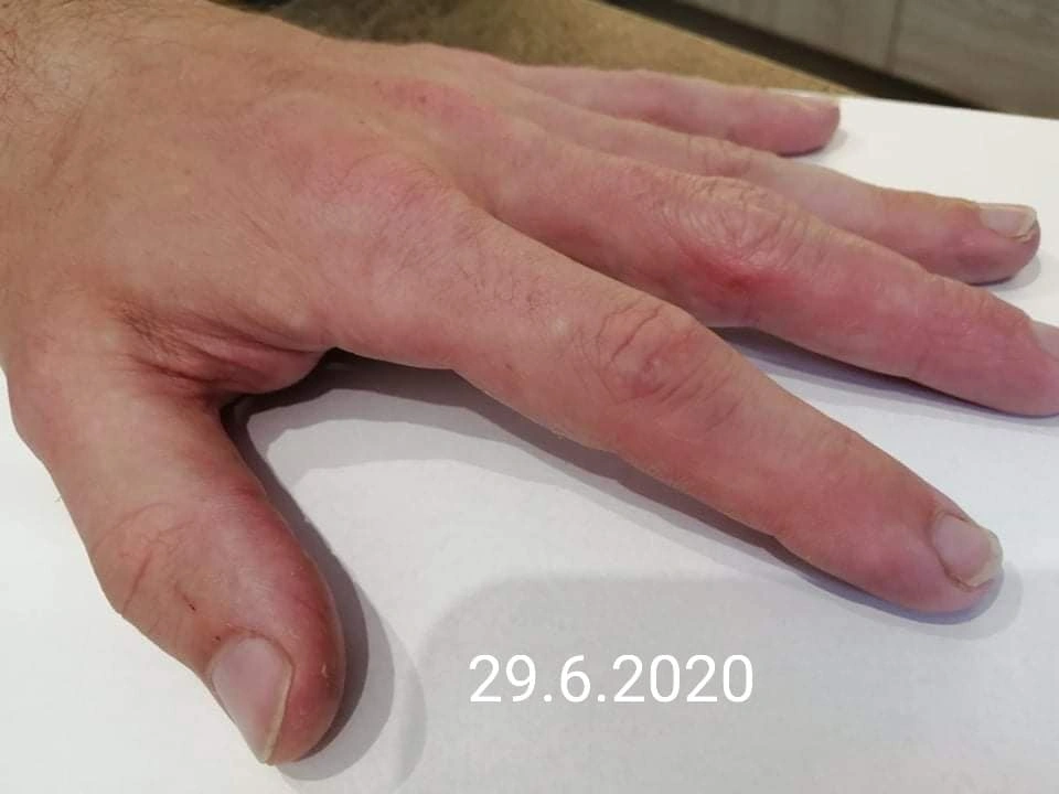 Zhojená kůže na rukou &ndash; stav po kúře, 29. 6. 2020.