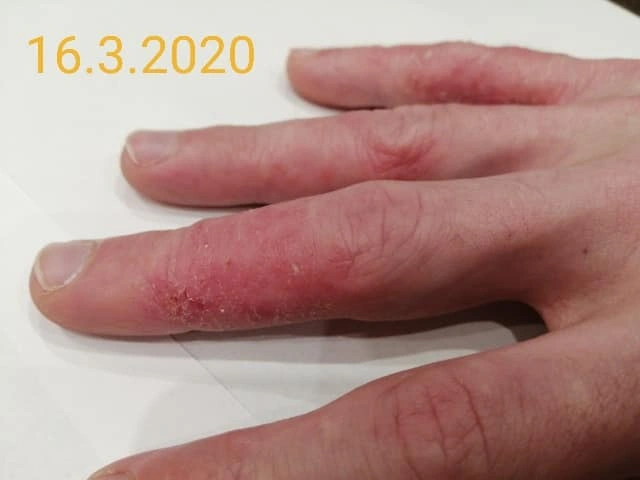 Vleklý ekzém na prstech &ndash; detail na začátku kúry, 16. 3. 2020.