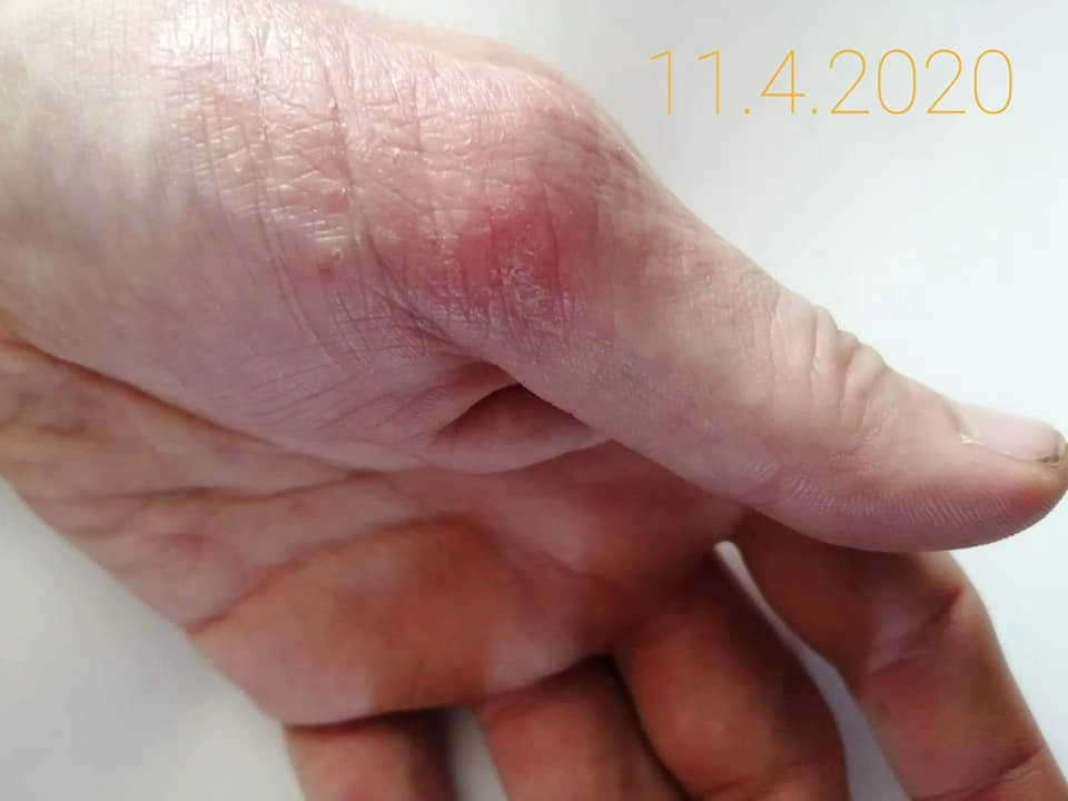 Vleklý ekzém na rukou &ndash; detail, 11. 4. 2020.
