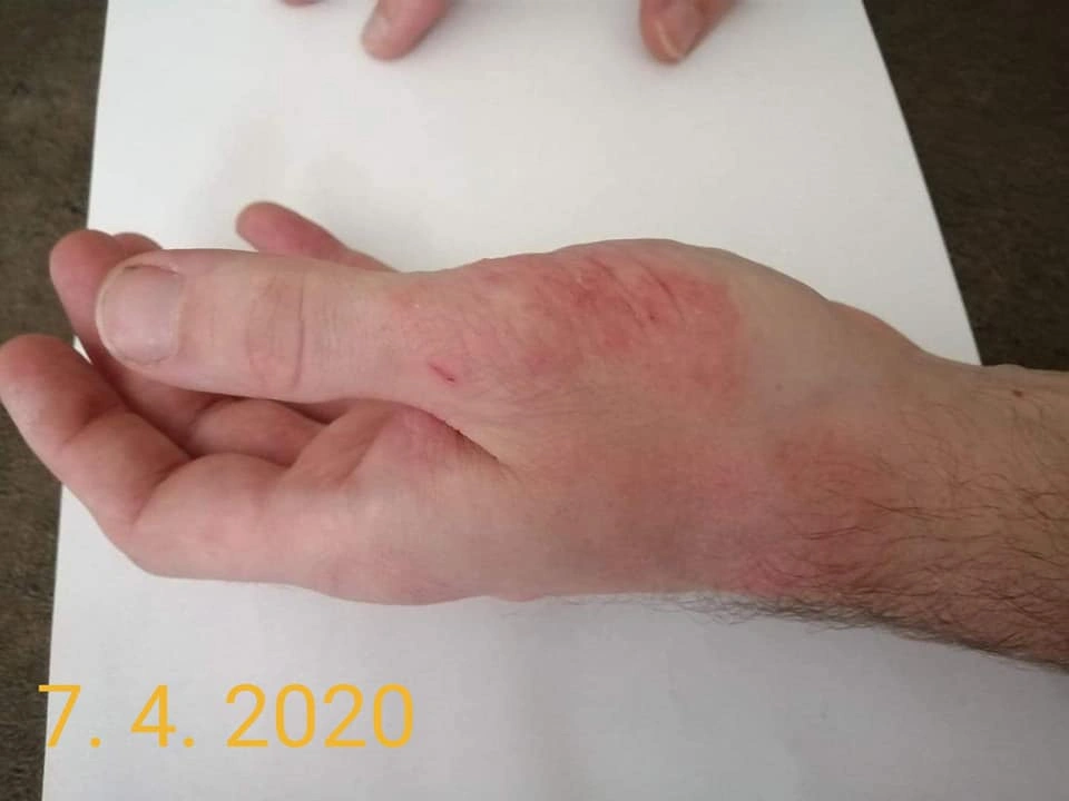 Vleklý ekzém na rukou &ndash; stav 7. 4. 2020.