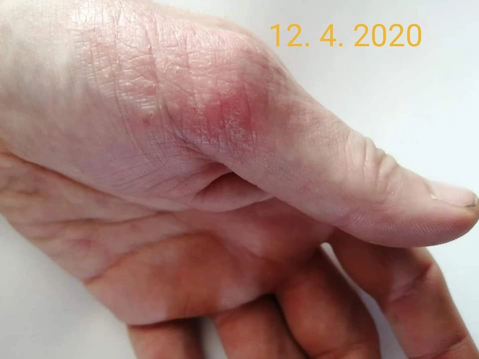 Vleklý ekzém na rukou &ndash; detail, 12. 4. 2020.