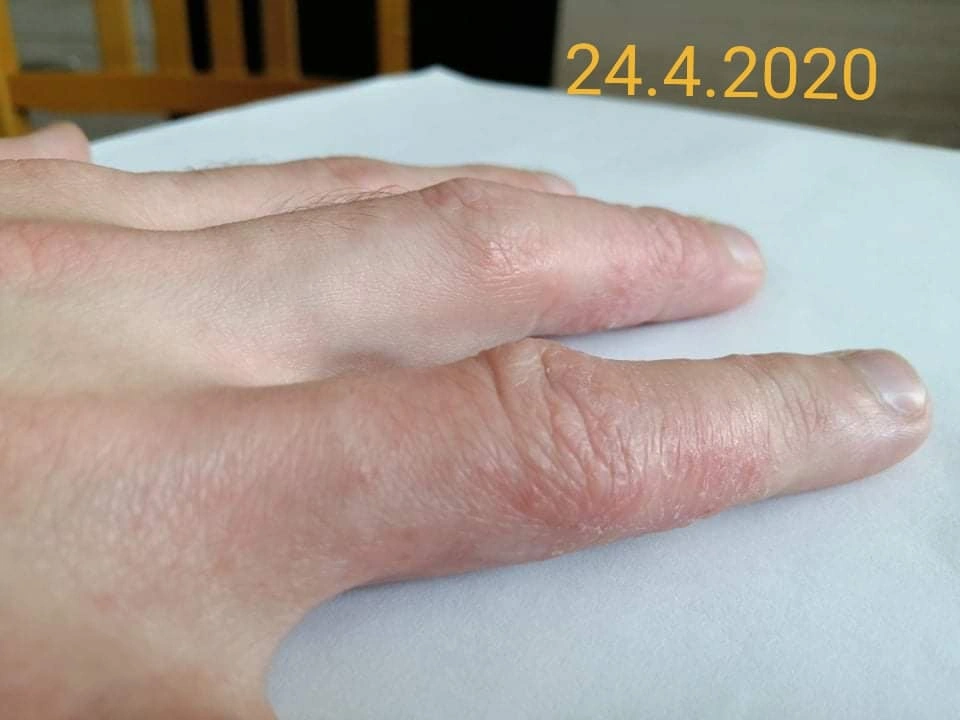 Vleklý ekzém na prstech &ndash; detail, 24. 4. 2020.